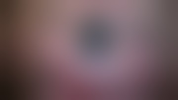 OCT assisted DMEK surgery