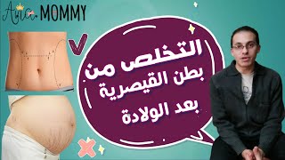 كيفية ربط البطن بعد الولادة .. التخلص مع الكرش بعد الولادة القيصرية والطبيعية مع د / محمد بدر