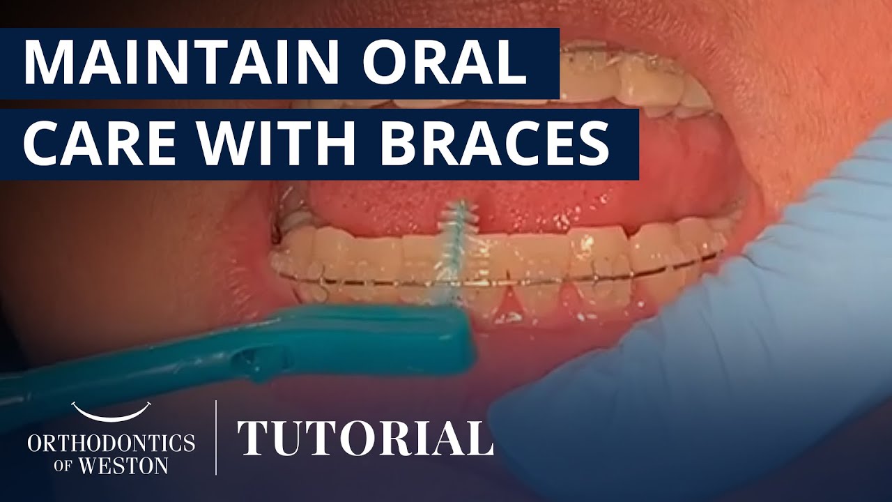 How to Maintain Oral Care While Wearing Braces | Orthodontics of Weston ...