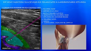 Ultrasound Guided Hip Joint Injection With In A 58 Year Old Female With A Moderatelarge Effusion