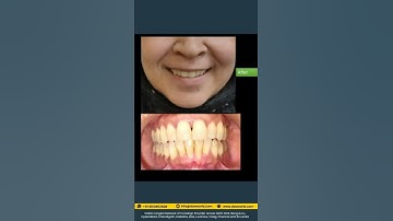 Transform smile with 𝐈𝐧𝐯𝐢𝐬𝐚𝐥𝐢𝐠𝐧 technology | Invisalign | Dr Amit