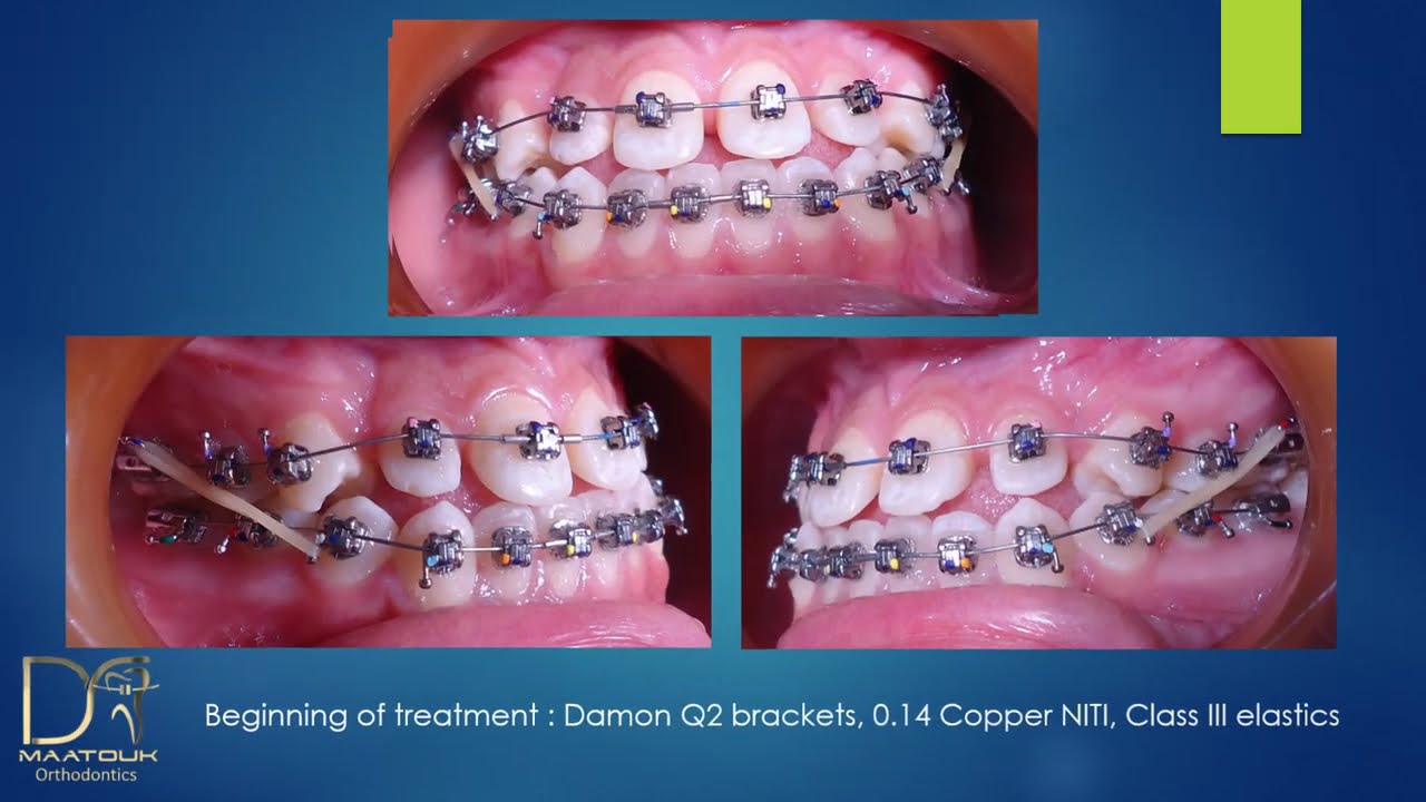 Treatment of canine impaction and lower anterior teeth protrusion with Damon System brackets