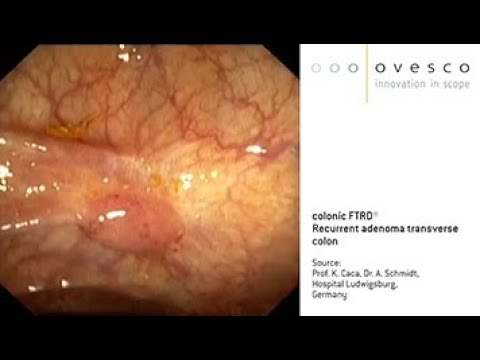 FTRD® System | colonic FTRD | Recurrent adenoma transverse colon