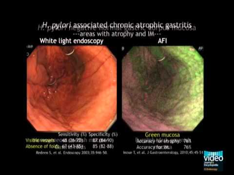 Advanced Imaging In The Diagnosis Of Gastric Intestinal Metaplasia