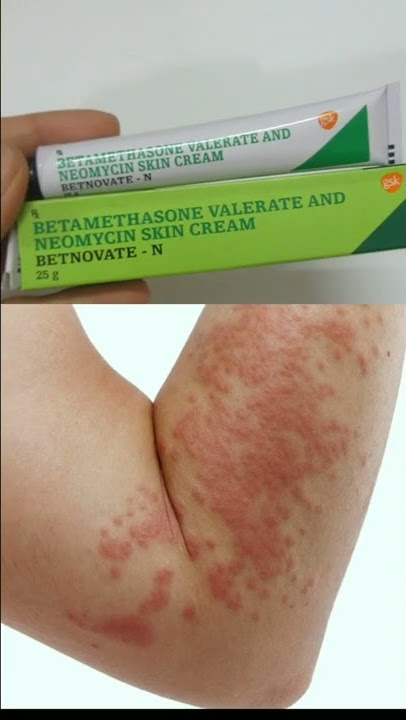 Batnovate N Cream For Fairness ? #shorts #skincare #skininfection #review