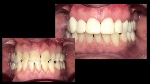 CEREC: 7 Crowns, 1 Visit...Complete Design Process!
