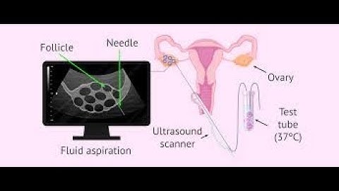 Aspiration CPT codes - simplify medical coding