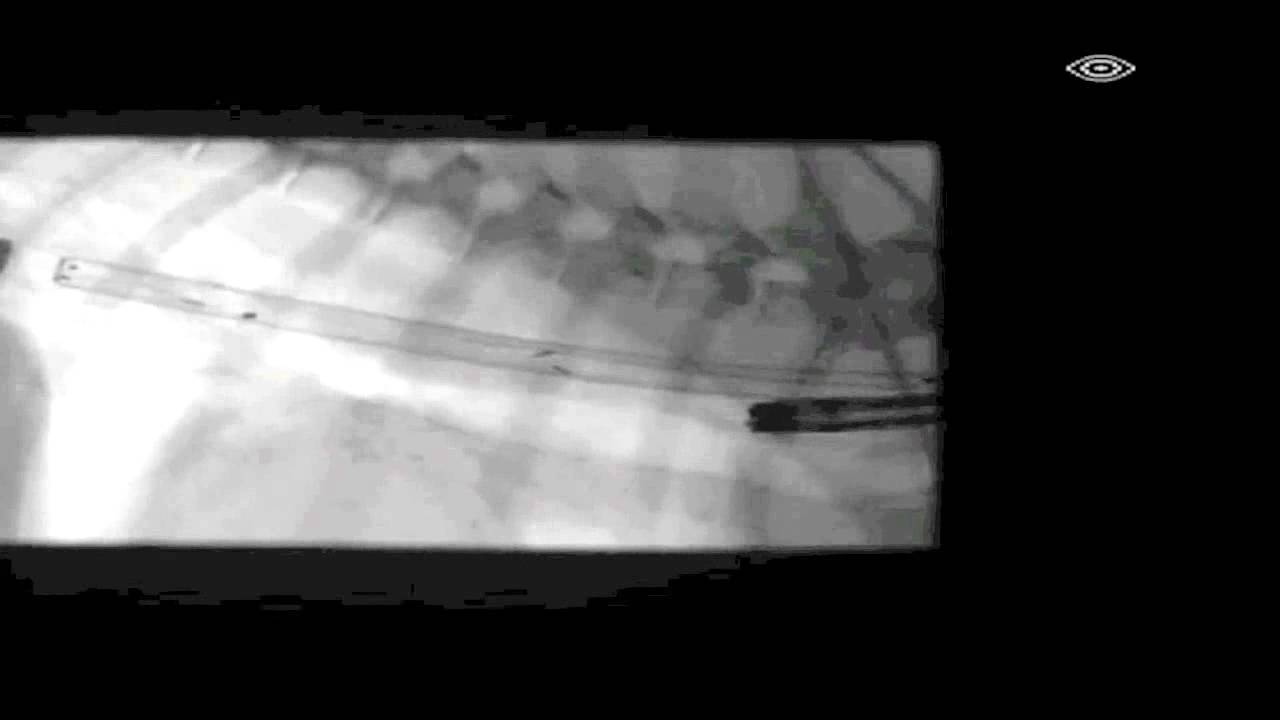 Esophageal Stricture Esophageal Stent Placement