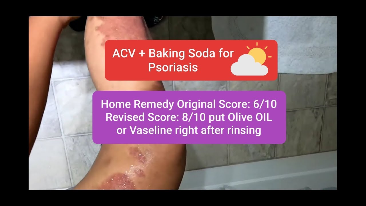 Psoriasis = Baking Soda + Apple Cider Vinegar Home Remedy *NO SELLING