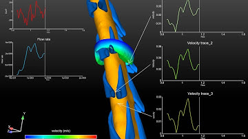 CFD Simulation of CSF Velocity within a normal human spinal canal with velocity traces
