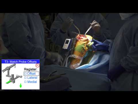 Total Knee Replacement with OrthAlign Surgical Navigation