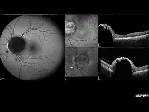 Vídeo: Relación Estructural-vascular-funcional Retiniana Mediante Tomografía De Coherencia óptica Y Tomografía De Coherencia óptica - Angiografía En La Miopía