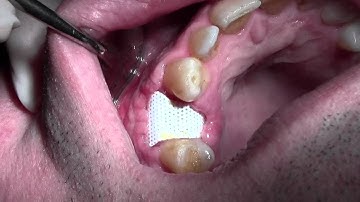 Bone Grafting #5 Site with Mineross/Cytoplast d-PTFE, 2 Week Post-op