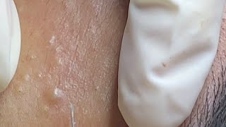 Acne treatment for Spa Linh Mun 2024 #59