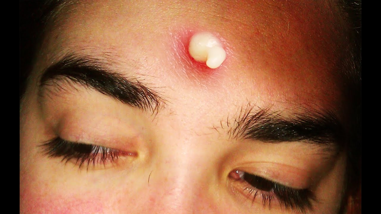 What Causes Whiteheads, Blackheads, Pimples & Comedones - YouTube