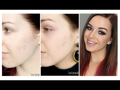 My Acne Scarring - treating them with Microdermabrasion