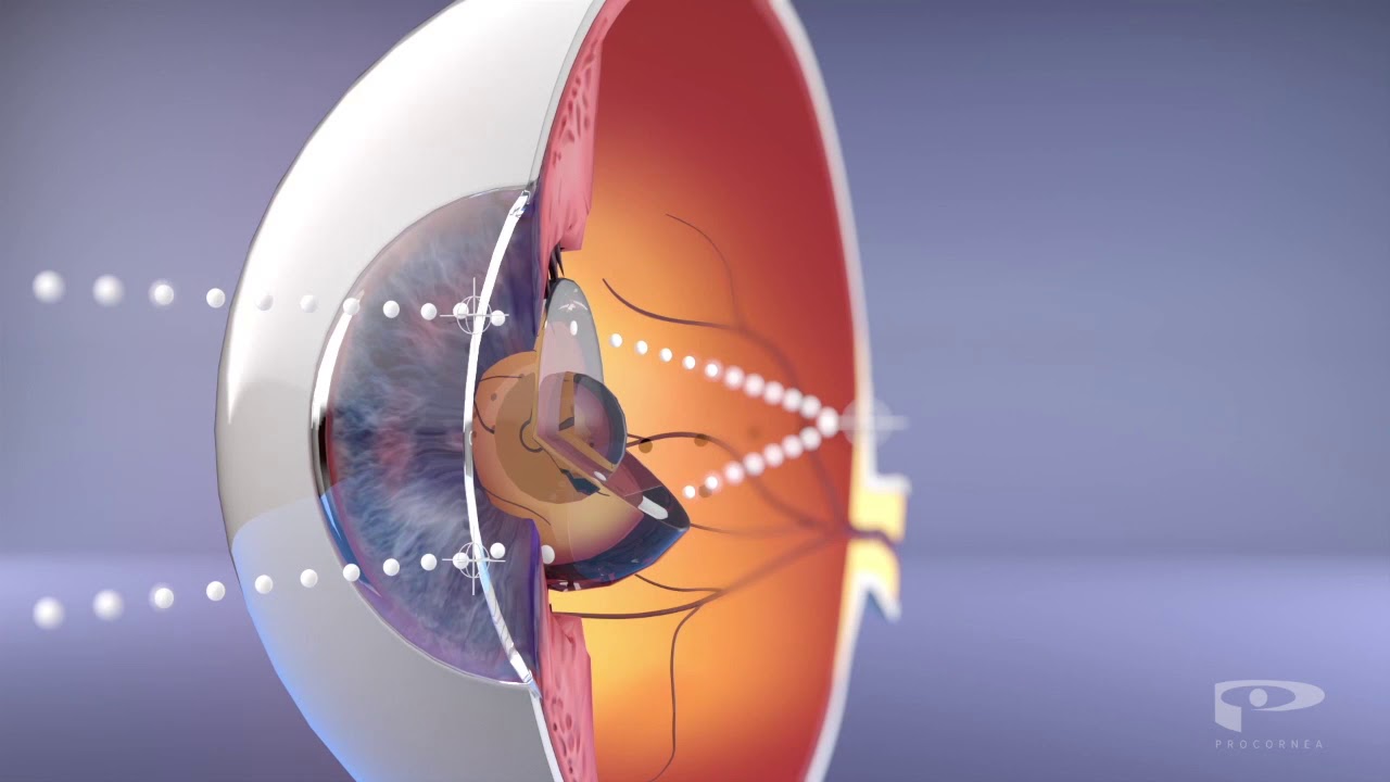What is OrthoK & How does it Control Myopia Progression? YouTube