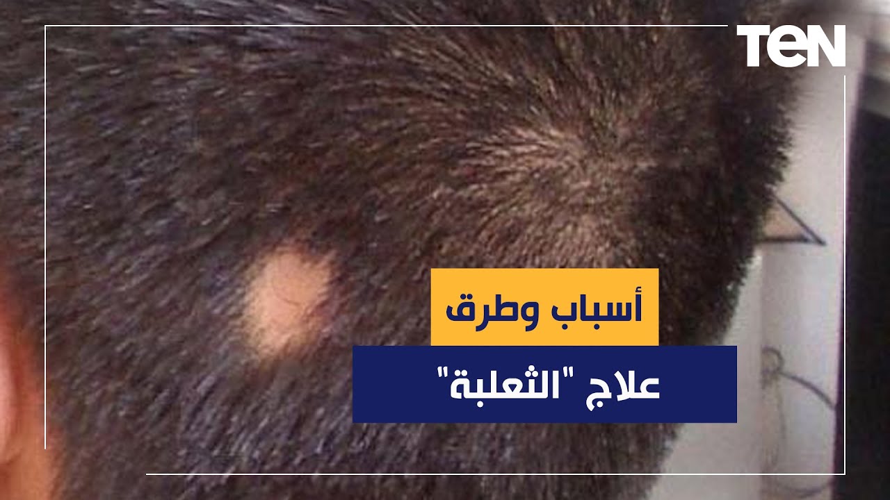 دكتور هاني الناظر يكشف أسباب وطرق علاج 