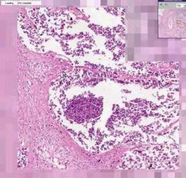Squamous Cell Carcinoma Lung Histology