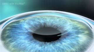 VisuMax – Treatment & Animation
