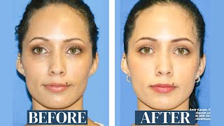 Facial Fat Transfer Results 9 Years Later  | Fat Transfer to cheeks, under eyes and temples