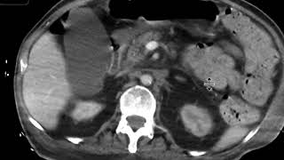 Left renal artery stenosis