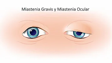 ¿Cuál es el hallazgo ocular más frecuente en la miastenia gravis?