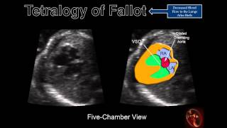 Fetal Echocardiography Tetralogy Of Fallot