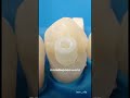 Больно ли ставить штифт в зубы? Запишитесь в «InSmile» за качественной работой и планом лечения.