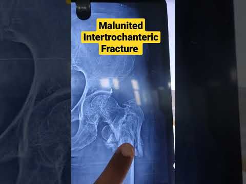 Βίντεο: Intertrochanteric από ιατρική άποψη;