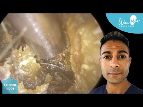 1,046 - Very Impacted Dry Ear Wax & Skin Removal