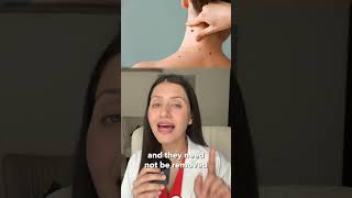 Keep Getting Moles ? Dr. Jushya Sarin