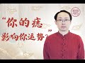 看顏色就知道你的痣是“吉”是“兇”，這一招必學！【面相】Color tells you whether your MOLE is &quot;good&quot; or &quot;bad&quot;.