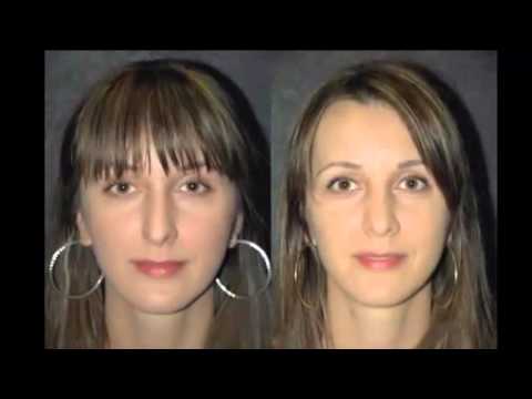 Rinoplastie Targu Jiu Clinici Preturi Pareri Youtube