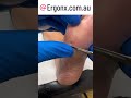 Podiatrist's Incredible Foot Corn Removal in Australia #CornRemoval #Podiatry