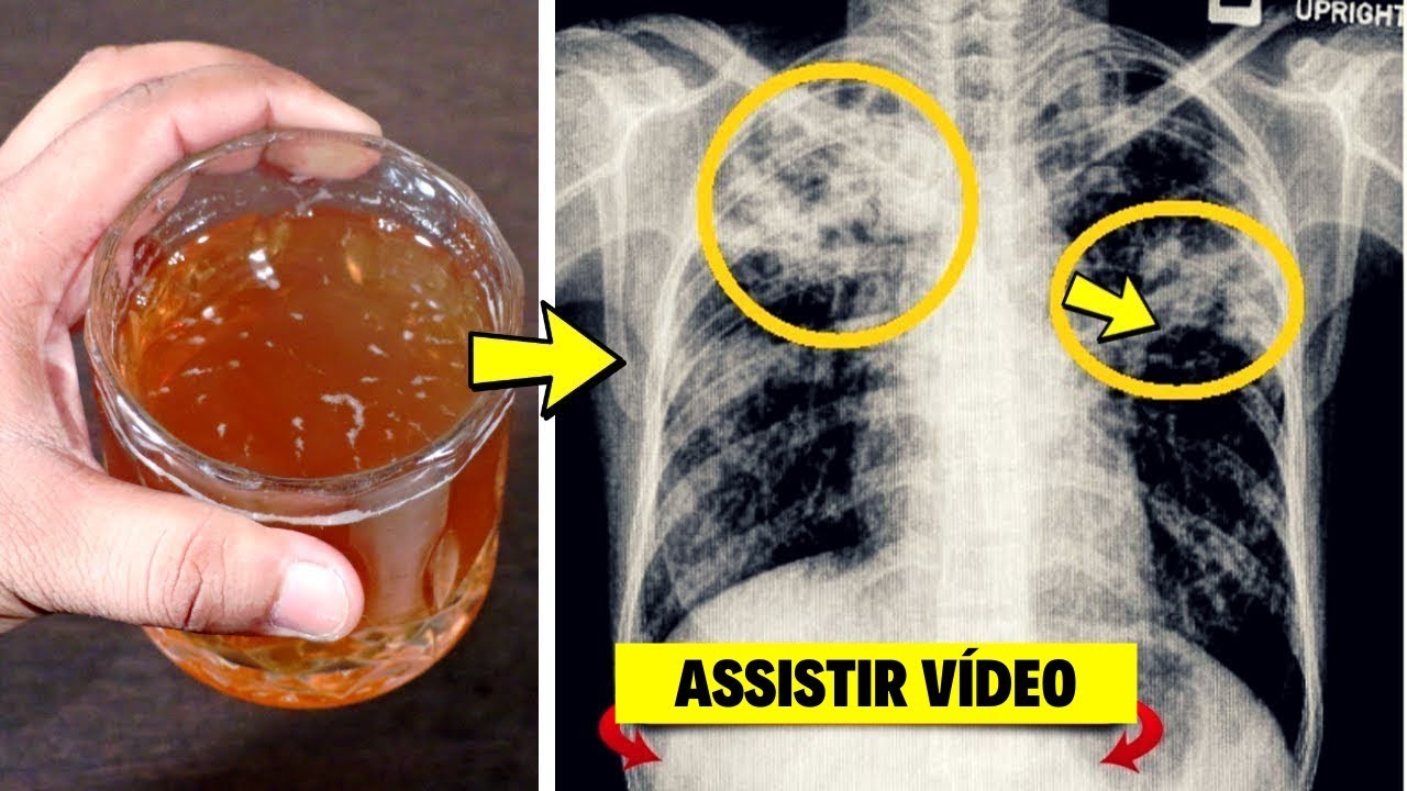 COMO LIMPAR SEU PULMÃO EM ATÉ 7 DIAS! RECEITA CASEIRA E NATURAL PARA O ...
