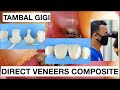 Step by step direct veneer composite restoration  dentist griya rr