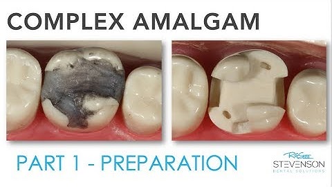 Complex Amalgam Preparation | Part 1