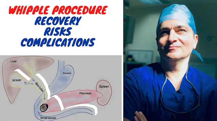 WHIPPLE PROCEDURE: RECOVERY, RISKS, and COMPLICATI...