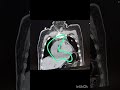 VATS Pericardial window #pericardium #thoracicsurgery #emergency #surgeryinnovation #teamwork