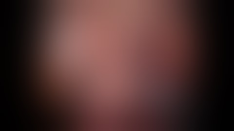 Robotic Lateral Pelvic Node dissection