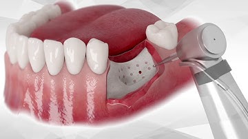 Bond Apatite® protocol for lateral augmentation