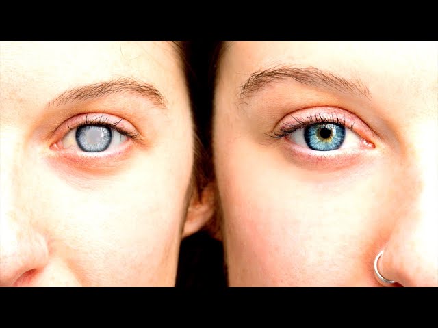 7 Best Eye Vitamins for Floaters that Reduce Floaters in Eyes!