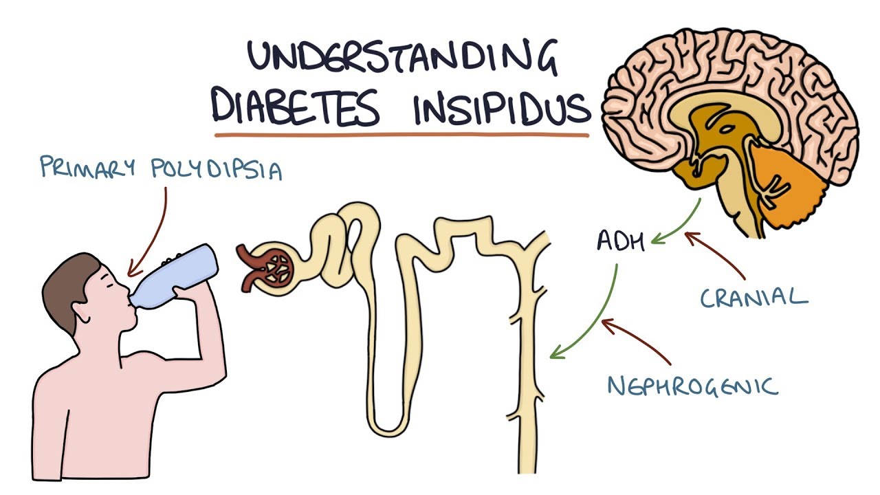 diabetes insipidus symptoms nursing
