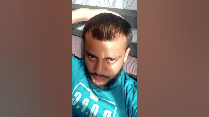 2 Year Hair Loss Transformation #baldcafe