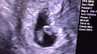 Sonogram: 7 weeks pregnant !