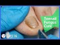 TOP MEDICAL PEDICURE Ep.116 - Toenail Fungus Treatment Tutorial