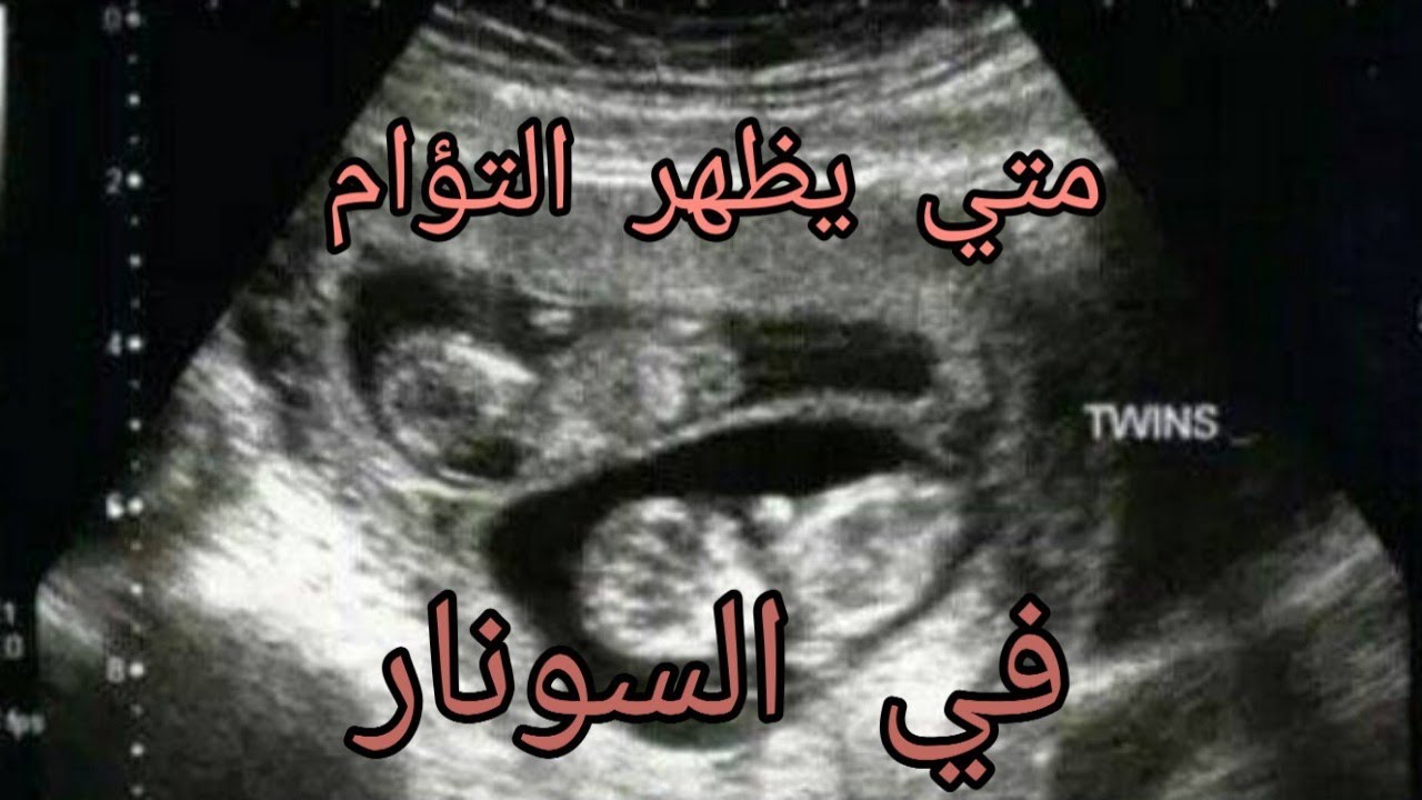 متى يظهر الحمل بتوأم بالسونار