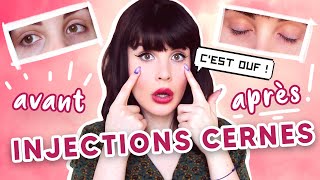 Mon expériences avec les injections dans les cernes.