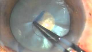 Capsulorhexis In Intumescent Cataract, Surgeon - Dr Pradip Mohanta
